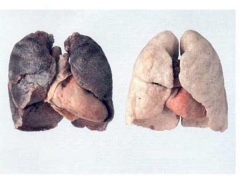 Ung thư phổi vì dê