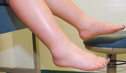 Bài thuốc nam chữa phù thũng