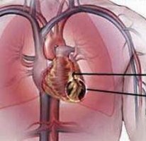 Bài thuốc  cách trị và đề phòng để khỏi bị thông tim